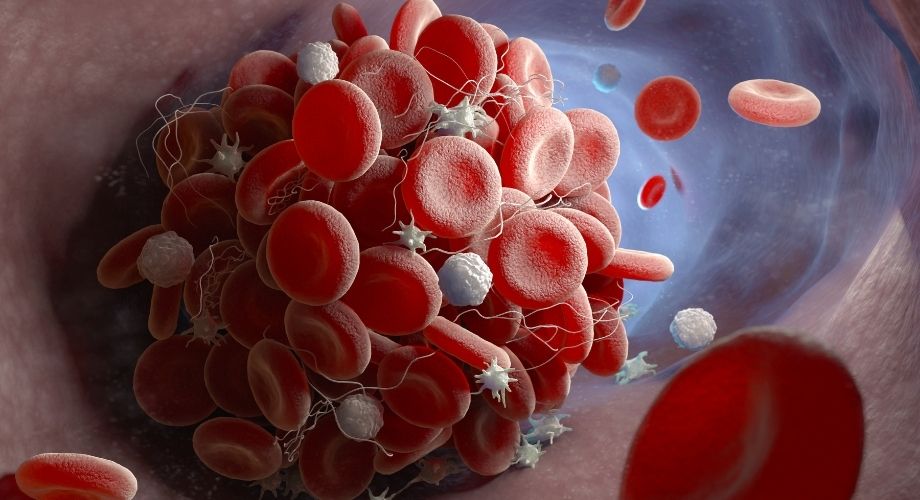 Estudos revelam melhores tratamentos para Tromboembolismo Venoso